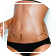 Abdominoplastia
